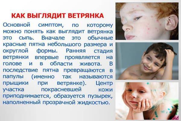 Чем лечить ветрянку у детей в домашних условиях: быстро и пошагово