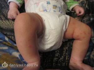 Прививка от полиомиелита: последствия и осложнения у детей