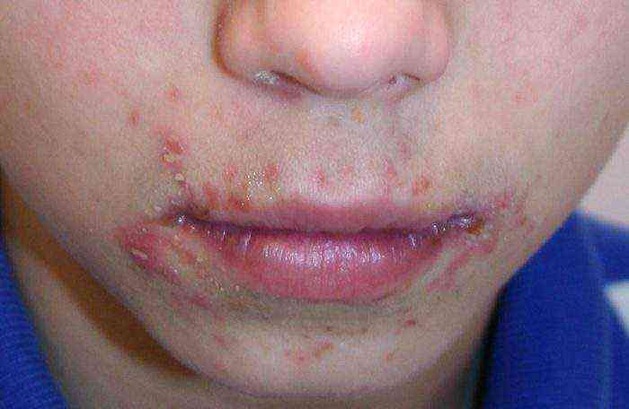 Сыпь на подбородке у ребенка: раздражение от слюней, аллергия и другие причины (фото с пояснениями)