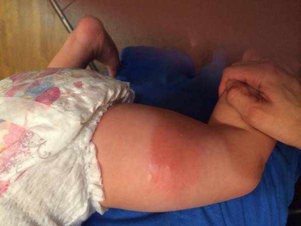 Ревакцинация АКДС: как переносится вторая и третья прививка - реакция и последствия