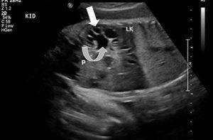 Пиелоэктазия почек у ребенка (двусторонняя, правого или левого органа) - что это такое?