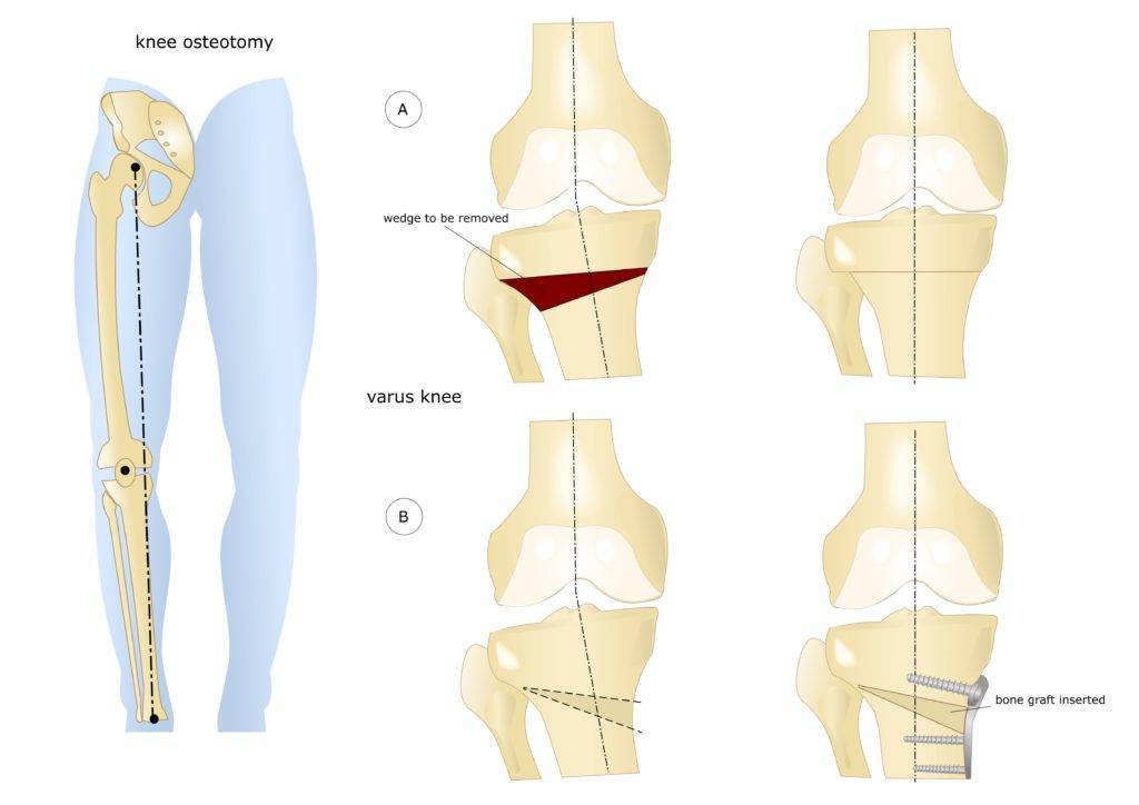Болят колени, суставы рук и ног после родов: причины болей при вставании, приседании и сгибании