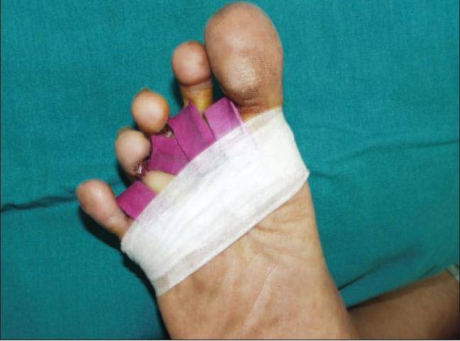 Фукорцин для детей: инструкция по применению при стрептодермии, ветрянке, опрелостях