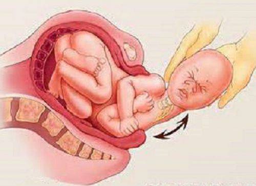 Перелом ключицы у новорожденного при родах: последствия для ребенка