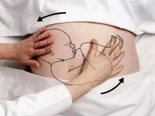 Кесарево сечение при тазовом предлежании: когда делают, как проходит, какие плюсы и минусы операции?