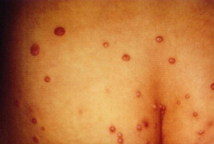 Контагиозный моллюск у детей: фото на коже, лечение и удаление на разных стадиях болезни