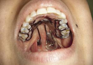 Волчья пасть у детей и заячья губа: причины патологий, фото до и после операции