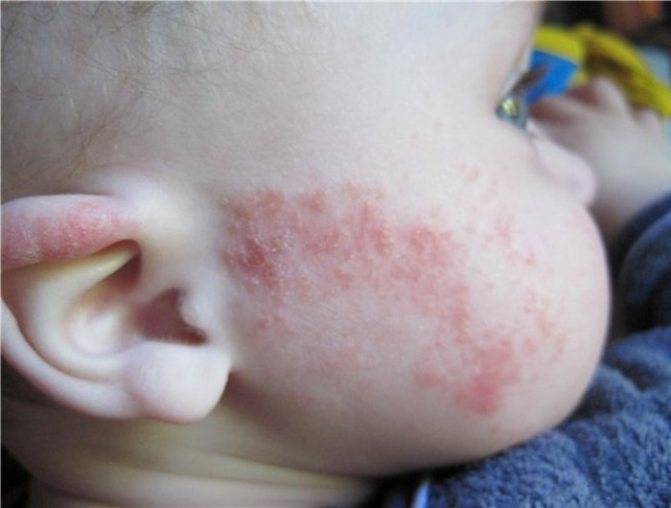 Симптомы и лечение лямблий в печени у детей, причины возникновения и возможные осложнения