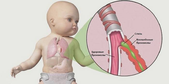 Причины возникновения бронхита у детей 2-3 лет, симптомы и лечение в домашних условиях