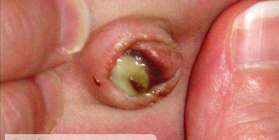 Обработка пупочной ранки у новорожденного ребенка в домашних условиях (пупка)