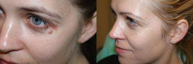 Когда у детей появляются родинки: в каком возрасте, можно ли удалять, к кому обратиться?