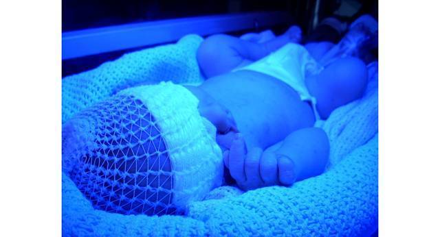 Фототерапия при желтухе у новорожденных: лечение в домашних условиях с помощью лампы