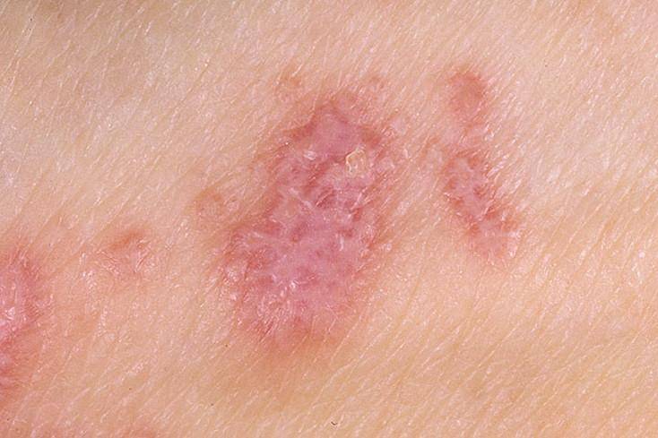 Стригущий лишай у детей на голове: фото, признаки и лечение в домашних условиях