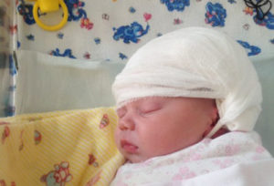 Кефалогематома у новорожденных на голове: последствия, лечение, пункция (фото)