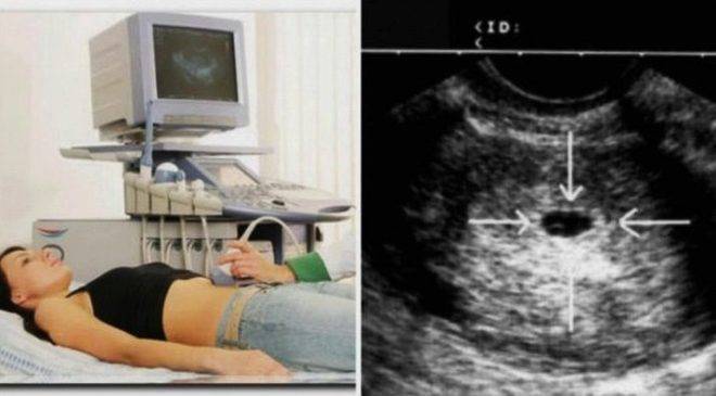 Тест на беременность после переноса эмбриона: на какой день он покажет две полоски?