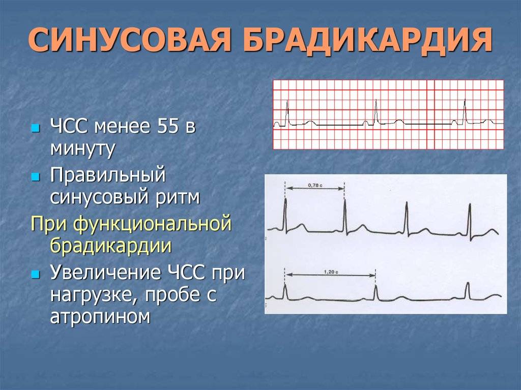 Если сердце малыша замедлилось: опасна ли брадикардия у детей?