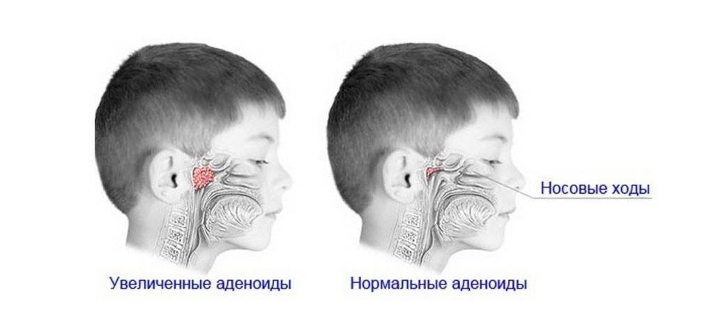 Аденоиды у детей: лечение, симптомы воспаления с фото в носу и горле, профилактика
