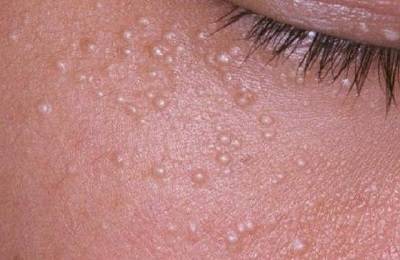 После родов прыщи на лице: почему появляются акне и сыпь и что делать?