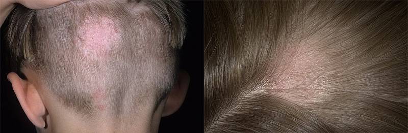 У ребенка выпадают волосы - что делать, почему это происходит, какое необходимо лечение?