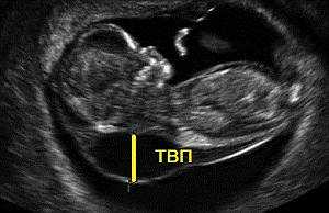Желточный мешок: норма по неделям беременности, размеры на ранних и поздних сроках