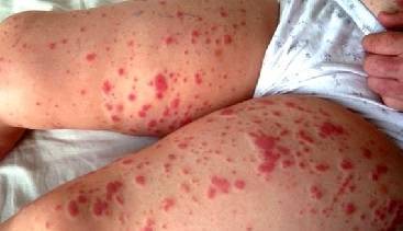 Причины возникновения геморрагического васкулита у детей, симптомы и лечение