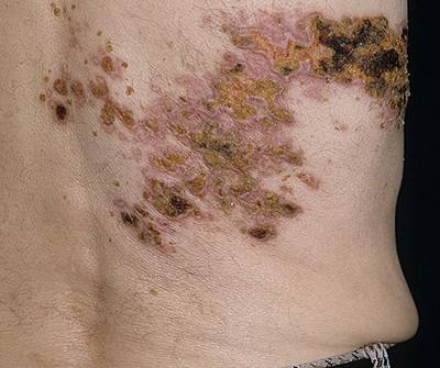 Опоясывающий лишай у детей - симптомы и лечение вируса герпес Зостер