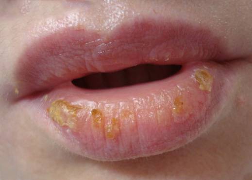 Почему на коже у ребенка может появиться белое пятно, что означает этот симптом?