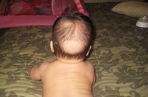 У ребенка выпадают волосы - что делать, почему это происходит, какое необходимо лечение?