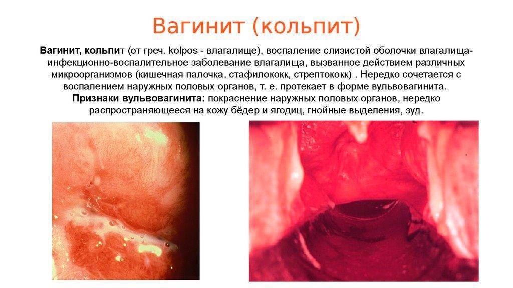 Хлоргексидин: инструкция по применению для полоскания горла у детей и промывания носа