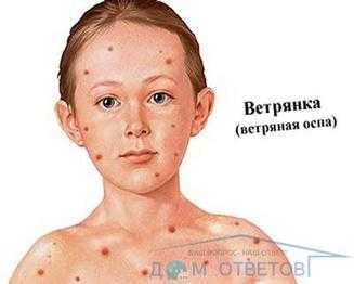 Можно ли купать ребенка при ветрянке, когда мыть после заболевания?