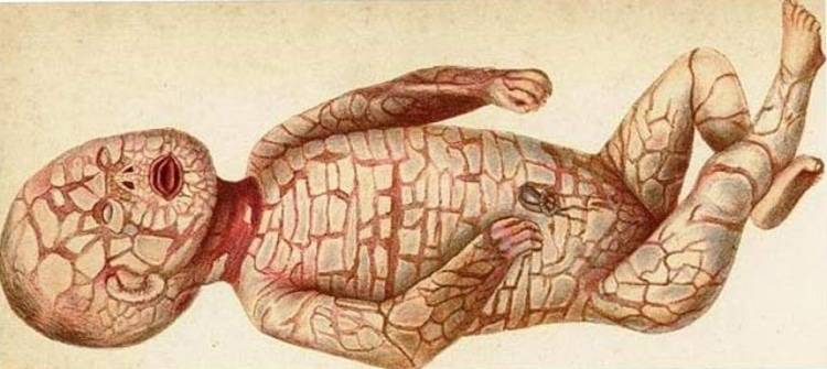 Ихтиоз кожи у детей: опасно ли это заболевание для новорожденных, что делать и как лечить?