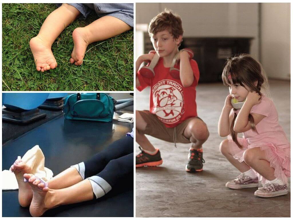 Вальгусная деформация коленных суставов у детей: лечение и применение ЛФК