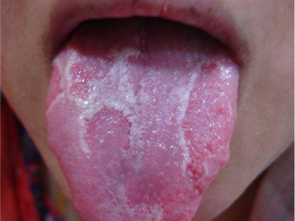 Географический язык у ребенка: причины возникновения, фото и лечение