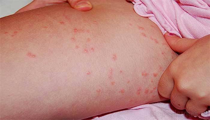 Чем мазать укусы блох у детей: симптомы и лечение аллергии, фото, обработка кожи